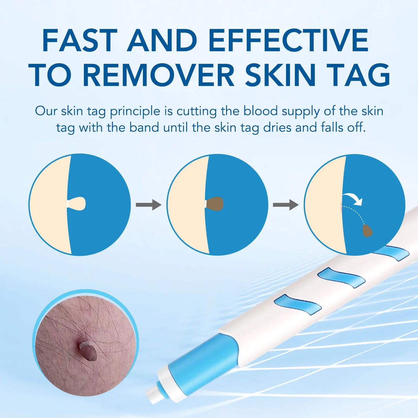 3 In 1 Painless Auto Skin Tag Mole Wart Removal Kit