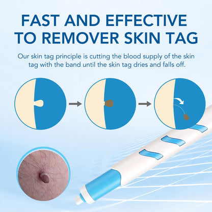 3 In 1 Painless Auto Skin Tag Mole Wart Removal Kit