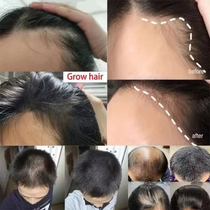 Fast Hair Growth Serum Spray - Anti Hair Loss & Baldness Treatment, Scalp Repair for Men & Women