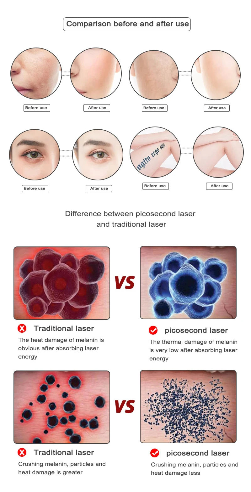Picosecond Laser Pointer - Mole, Dark Spot & Tattoo Removal Pen for Skin Pigment and Acne Treatment