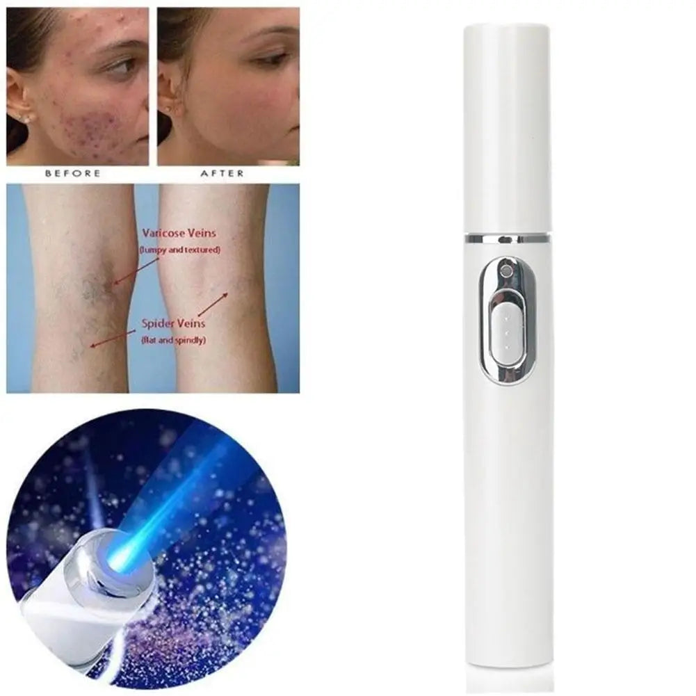 Blue Light Therapy Acne Laser Pen - LED Face Light for Scar & Wrinkle Removal Skin Care Device