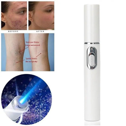 Blue Light Therapy Acne Laser Pen - LED Face Light for Scar & Wrinkle Removal Skin Care Device
