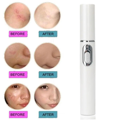 Blue Light Therapy Acne Laser Pen - LED Face Light for Scar & Wrinkle Removal Skin Care Device