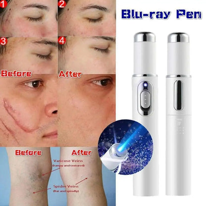 Blue Light Therapy Acne Laser Pen - LED Face Light for Scar & Wrinkle Removal Skin Care Device