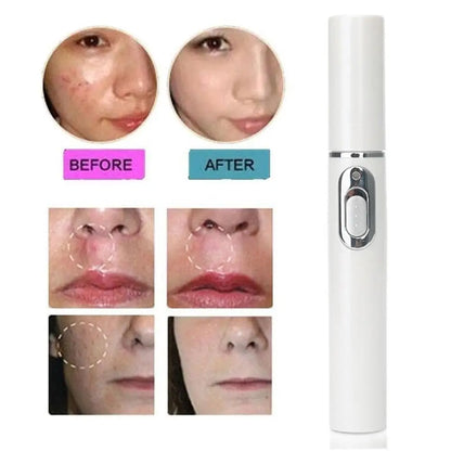 Blue Light Therapy Acne Laser Pen - LED Face Light for Scar & Wrinkle Removal Skin Care Device