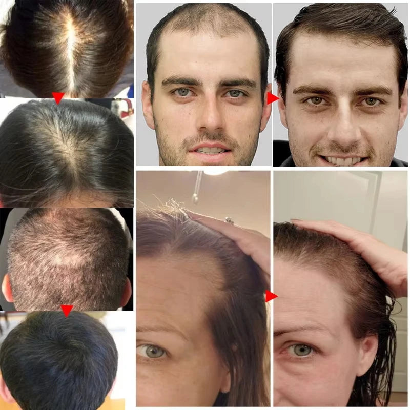 Fast Hair Growth Serum Spray - Anti Hair Loss & Baldness Treatment, Scalp Repair for Men & Women