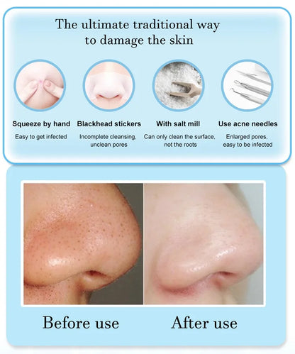 3-Suction Mode Face Cleansing Beauty Machine - Blackhead Removal & Dead Skin Remover Vacuum